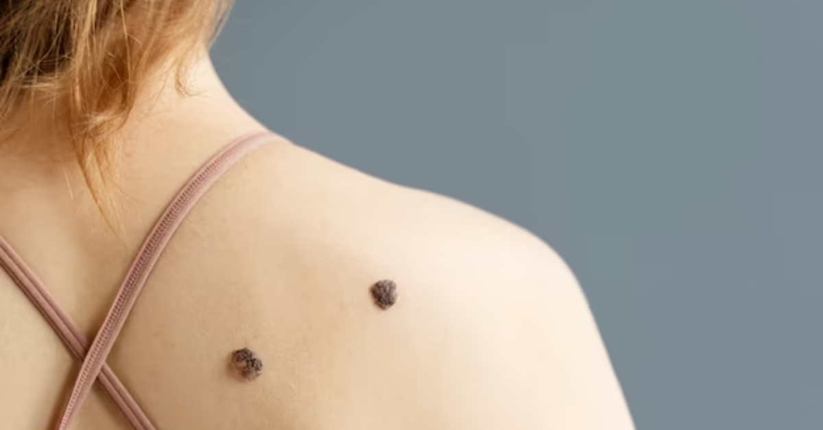 skin tags